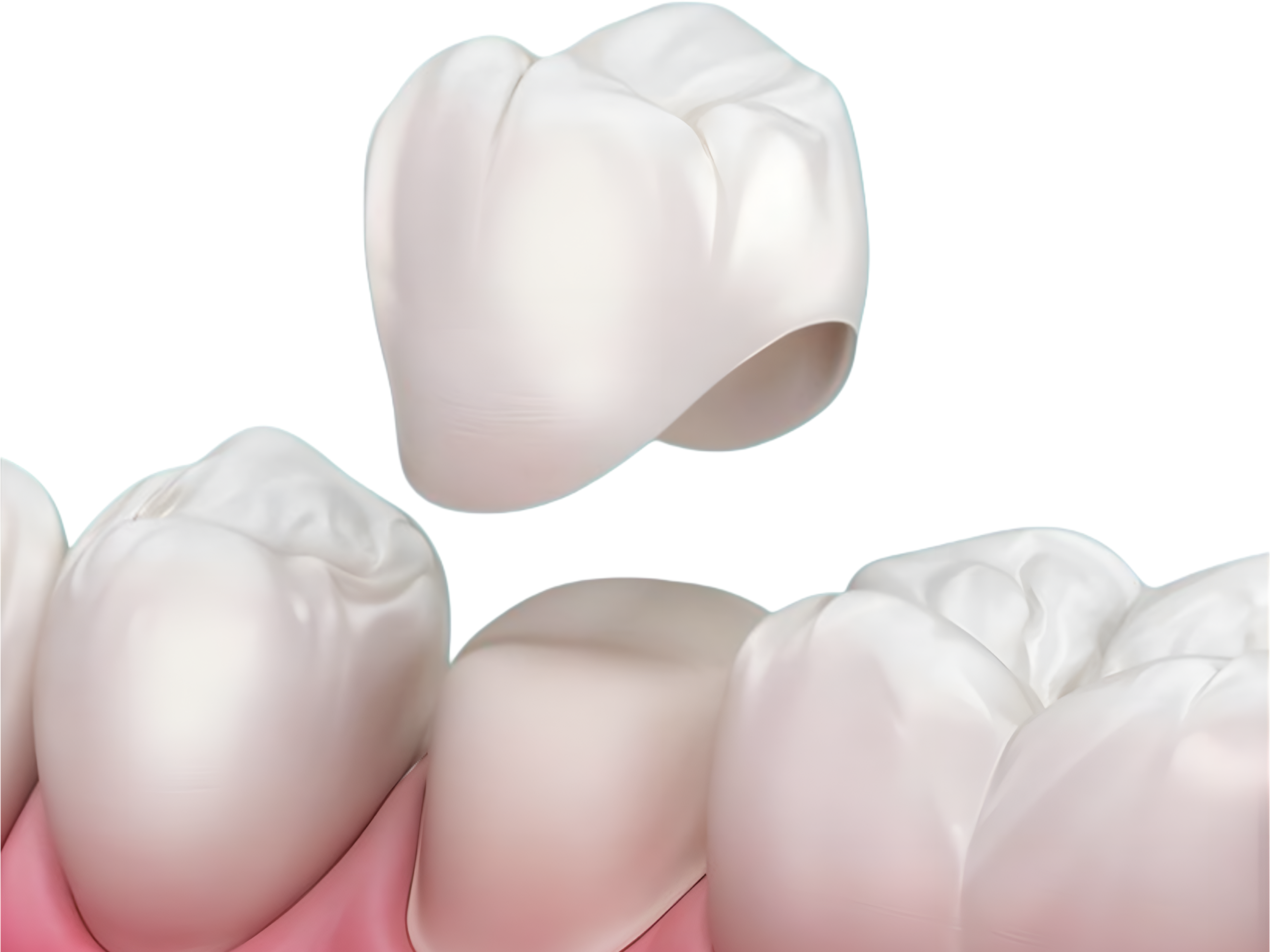 Keramička zubna krunica za obnovu oštećenog zuba