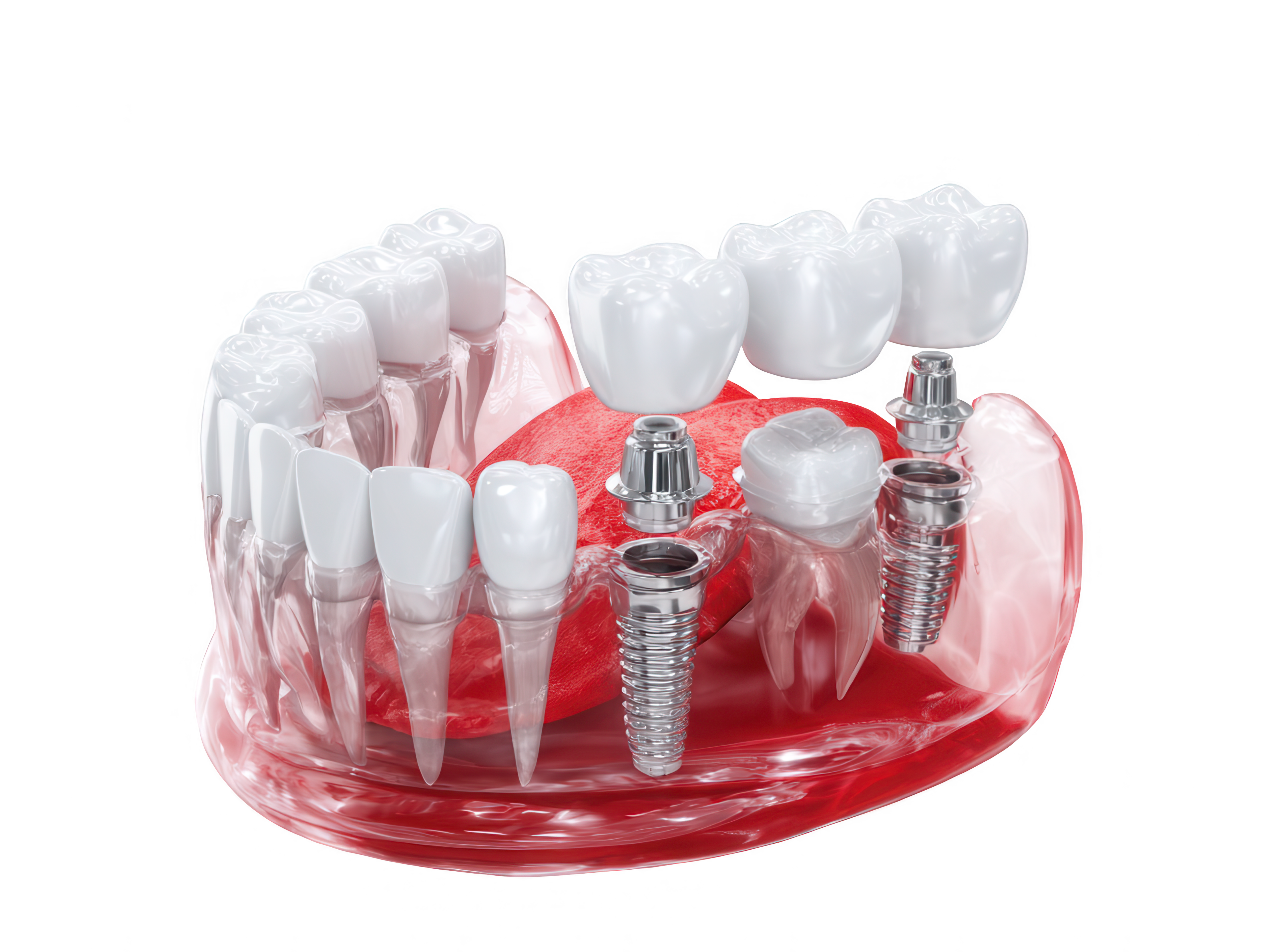 Dentalni most koji nadoknađuje jedan ili više izgubljenih zuba